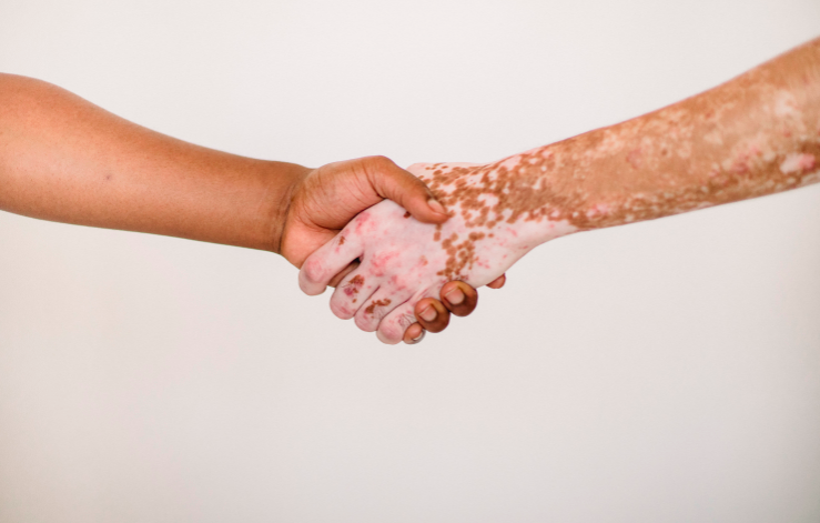 Vitiligo: principais causas, sintomas e tratamento