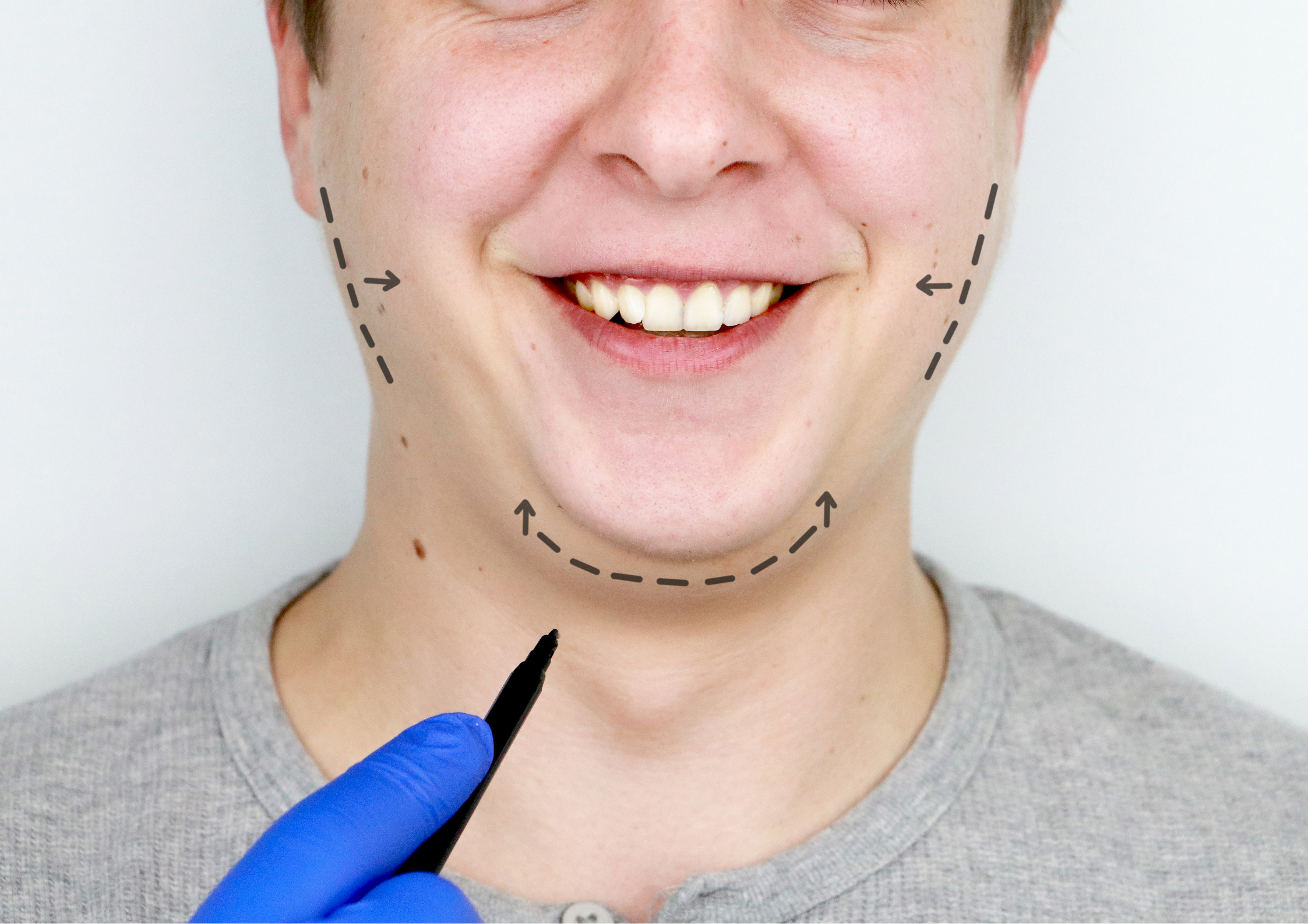 Mentoplastia